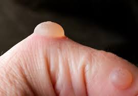 Understanding Blisters: Causes, Types, and Care